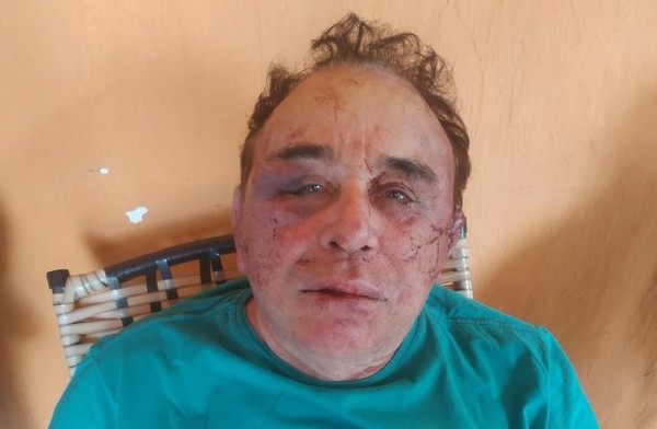 You are currently viewing Candidato a prefeito de Santa Terezinha-PB, é agredido durante assalto em fazenda da família