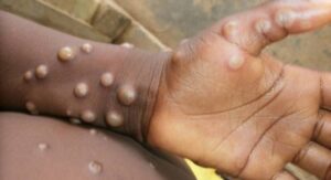 Read more about the article Varíola dos macacos é mais uma doença que preocupa o mundo