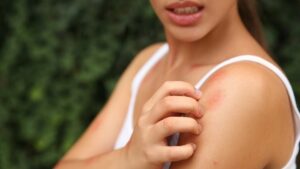 Read more about the article Estudo explica por que há pessoas que atraem mais mosquitos do que outras