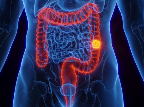 Leia mais sobre o artigo SUS terá novo protocolo para detectar câncer de intestino antes dos sintomas